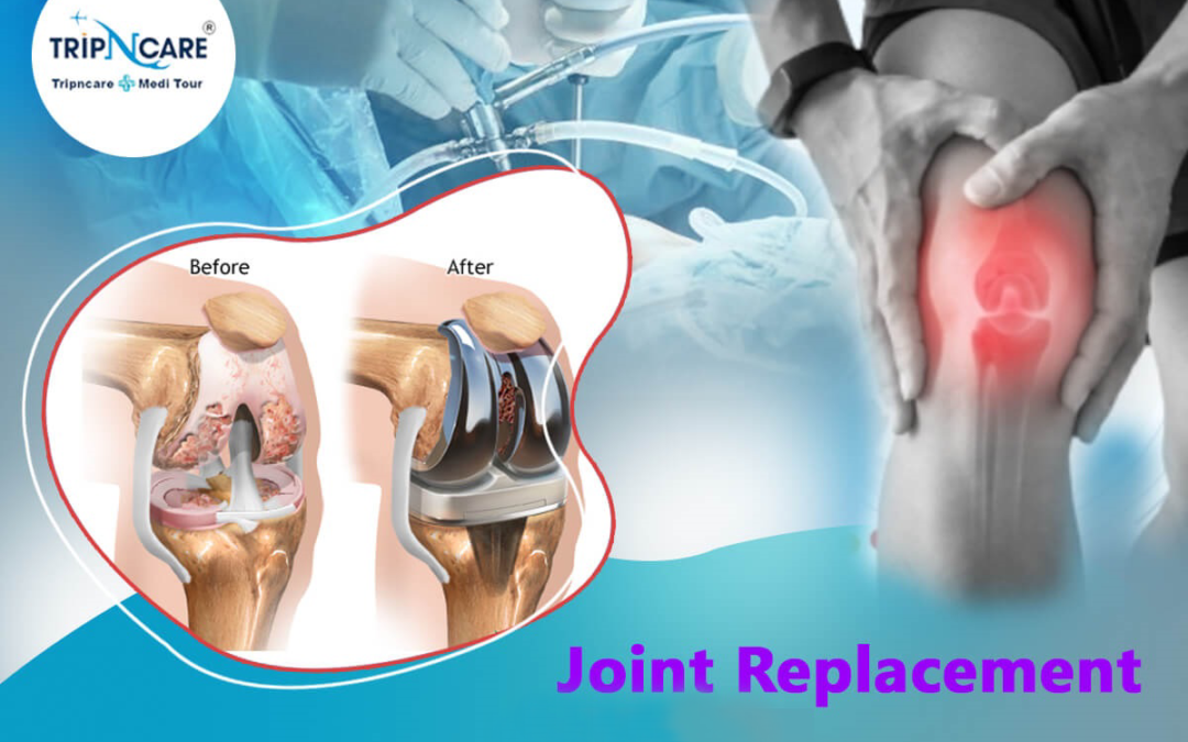 Plan these things before visiting the best joint replacement surgeon in India 
