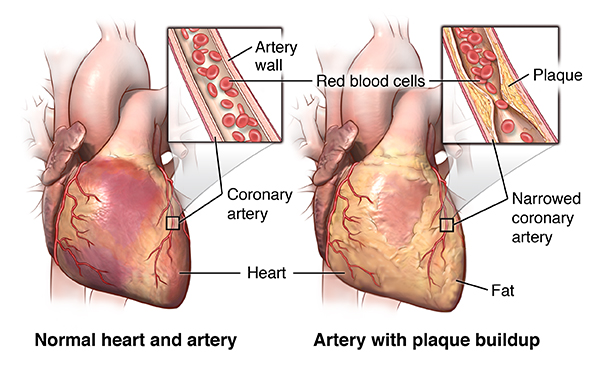 Front view of the heart with comparing a healthy artery vs. an artery with plaque buildup